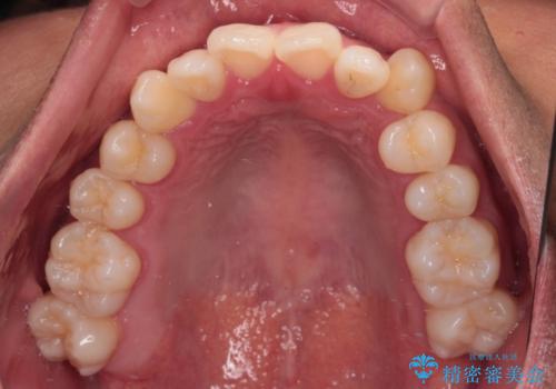 急速拡大装置 歯列弓を拡大して非抜歯ワイヤー矯正の治療前
