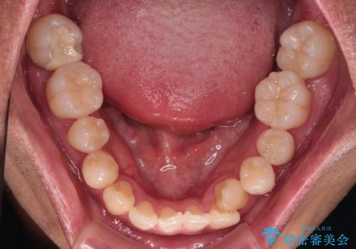 急速拡大装置 歯列弓を拡大して非抜歯ワイヤー矯正の治療前