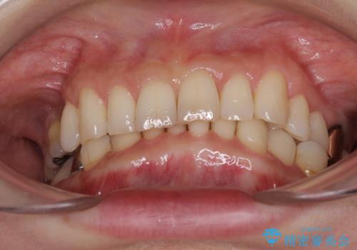 デコボコの歯とむし歯 インビザライン矯正治療とむし歯治療の治療前