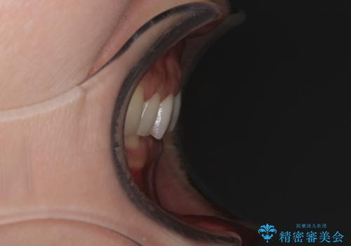 デコボコの歯とむし歯 インビザライン矯正治療とむし歯治療の治療前