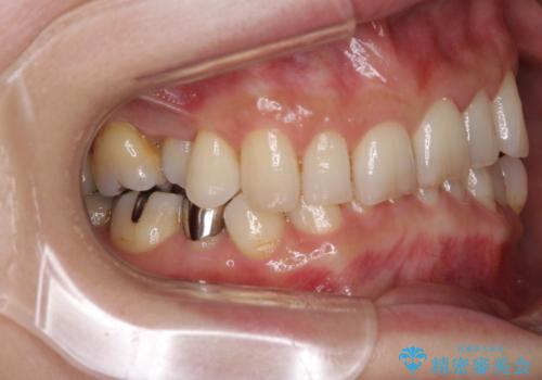 デコボコの歯とむし歯 インビザライン矯正治療とむし歯治療の治療前