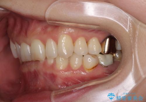 デコボコの歯とむし歯 インビザライン矯正治療とむし歯治療の治療前