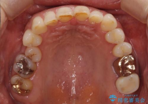 デコボコの歯とむし歯 インビザライン矯正治療とむし歯治療の治療前