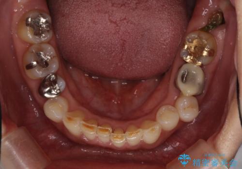 デコボコの歯とむし歯 インビザライン矯正治療とむし歯治療の治療前