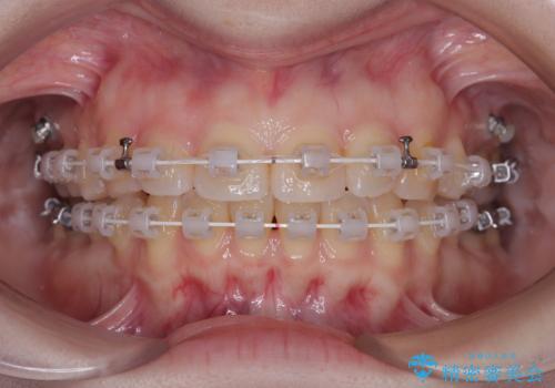 左上の前歯が出ているのが気になる 審美装置による非抜歯ワイヤー矯正の治療中