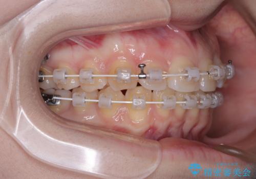 左上の前歯が出ているのが気になる　審美装置による非抜歯ワイヤー矯正の治療中