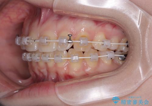 左上の前歯が出ているのが気になる　審美装置による非抜歯ワイヤー矯正の治療中
