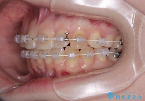 左上の前歯が出ているのが気になる 審美装置による非抜歯ワイヤー矯正の治療中