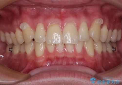 上下のデコボコを治したい インビザラインによる矯正治療の治療中