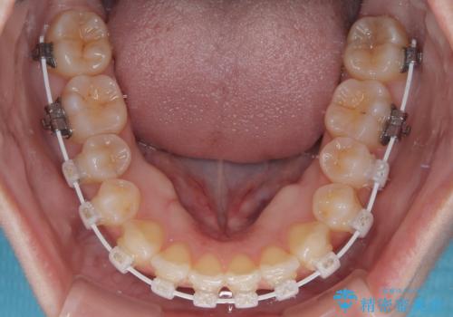 左上の前歯が出ているのが気になる 審美装置による非抜歯ワイヤー矯正の治療中