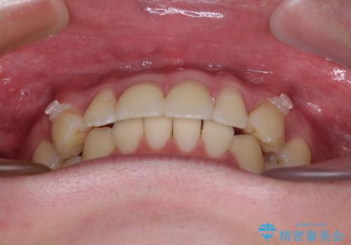 上下のデコボコを治したい インビザラインによる矯正治療の治療中