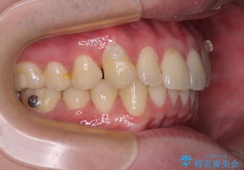 上下のデコボコを治したい インビザラインによる矯正治療の治療中