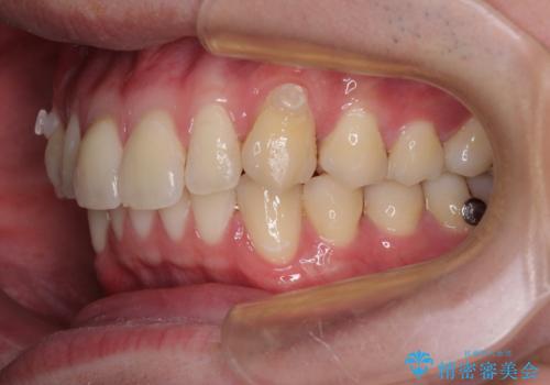上下のデコボコを治したい インビザラインによる矯正治療の治療中