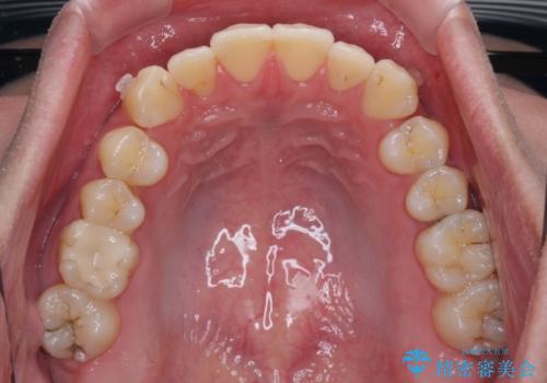 上下のデコボコを治したい インビザラインによる矯正治療の治療中