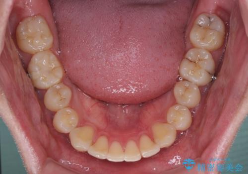 上下のデコボコを治したい インビザラインによる矯正治療の治療中