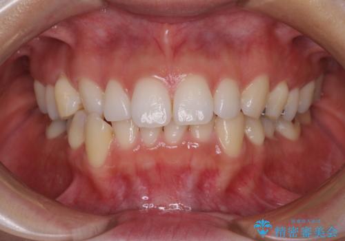顎先に梅干し皺ができる 閉じにくい唇を抜歯矯正で閉じやすくの症例 治療前