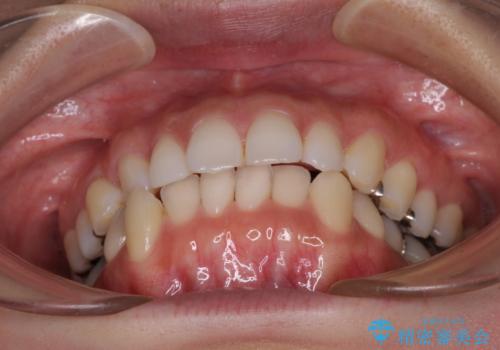 顎先に梅干し皺ができる 閉じにくい唇を抜歯矯正で閉じやすくの治療前