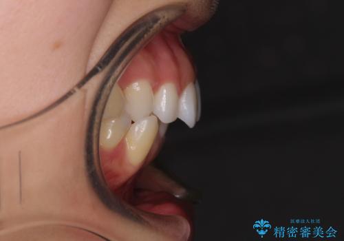 顎先に梅干し皺ができる 閉じにくい唇を抜歯矯正で閉じやすくの治療前