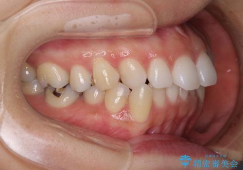 顎先に梅干し皺ができる 閉じにくい唇を抜歯矯正で閉じやすくの治療前