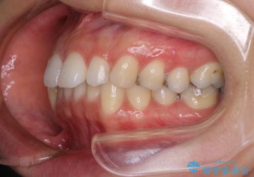 顎先に梅干し皺ができる 閉じにくい唇を抜歯矯正で閉じやすくの治療前