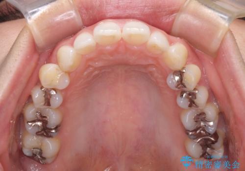 顎先に梅干し皺ができる 閉じにくい唇を抜歯矯正で閉じやすくの治療前