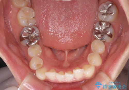 顎先に梅干し皺ができる 閉じにくい唇を抜歯矯正で閉じやすくの治療前