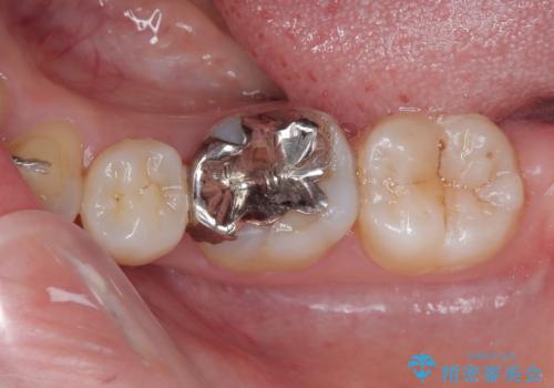 銀歯のところがしみる オールセラミッククラウンの治療前