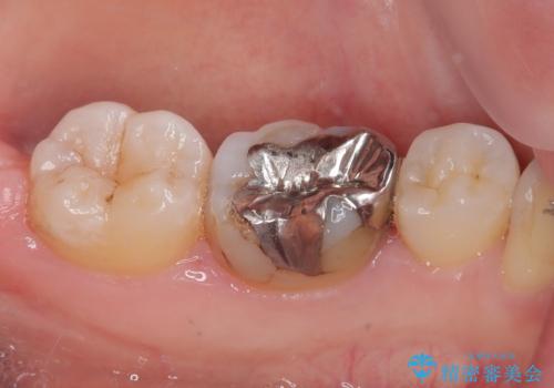 銀歯のところがしみる オールセラミッククラウンの治療前
