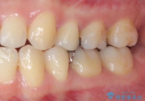 銀歯のところがしみる オールセラミッククラウンの治療前