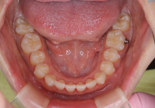 前歯のがたつきとディープバイト:インビザライン治療の治療中