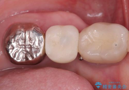 【1Dayインプラント治療! 低侵襲で短期間での治療】 咬むと歯が痛い! 歯根破折の症例 治療後