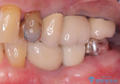 【1Dayインプラント治療! 低侵襲で短期間での治療】 咬むと歯が痛い! 歯根破折の治療後