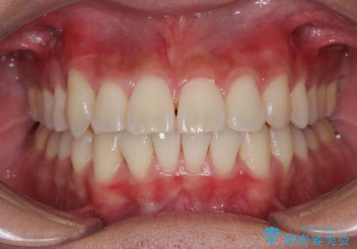 八重歯を無理なくなおしたい ワイヤー装置による非抜歯矯正治療