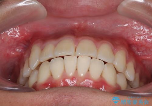 八重歯を無理なくなおしたい ワイヤー装置による非抜歯矯正治療の治療後