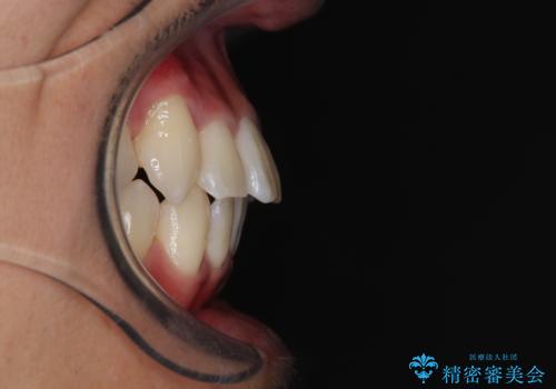八重歯を無理なくなおしたい ワイヤー装置による非抜歯矯正治療の治療後