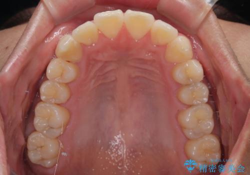 八重歯を無理なくなおしたい　ワイヤー装置による非抜歯矯正治療の治療後