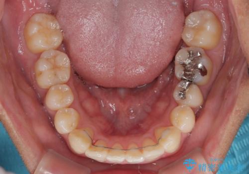 八重歯を無理なくなおしたい ワイヤー装置による非抜歯矯正治療の治療後