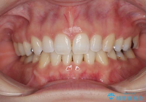 顎先に梅干し皺ができる 閉じにくい唇を抜歯矯正で閉じやすくの症例 治療後