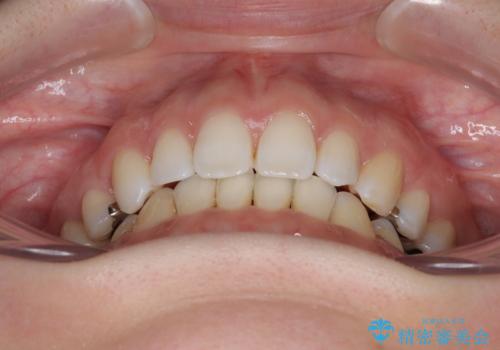 顎先に梅干し皺ができる 閉じにくい唇を抜歯矯正で閉じやすくの治療後