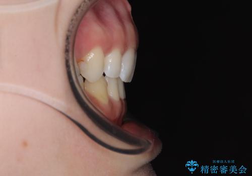 顎先に梅干し皺ができる 閉じにくい唇を抜歯矯正で閉じやすくの治療後