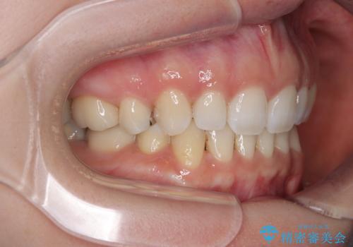 顎先に梅干し皺ができる 閉じにくい唇を抜歯矯正で閉じやすくの治療後