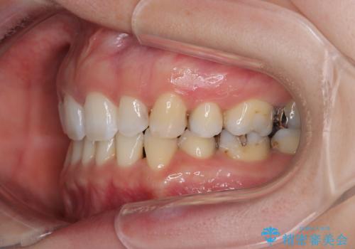 顎先に梅干し皺ができる 閉じにくい唇を抜歯矯正で閉じやすくの治療後