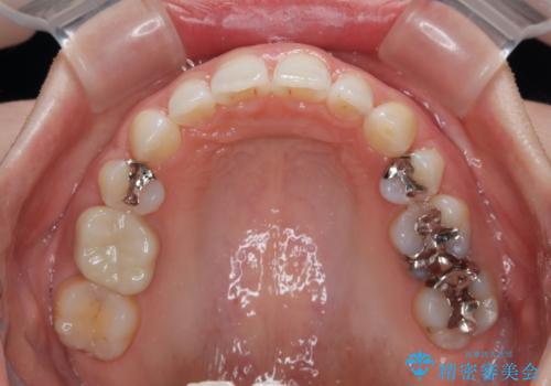 顎先に梅干し皺ができる 閉じにくい唇を抜歯矯正で閉じやすくの治療後
