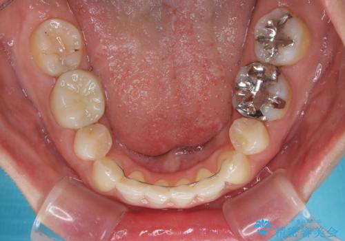 顎先に梅干し皺ができる　閉じにくい唇を抜歯矯正で閉じやすくの治療後