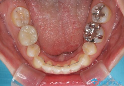 顎先に梅干し皺ができる 閉じにくい唇を抜歯矯正で閉じやすくの治療後