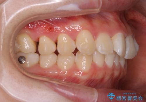 【非抜歯】インビザラインで正しい噛み合わせを