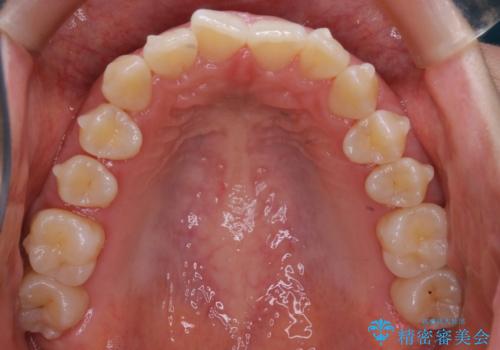 【非抜歯】インビザラインで正しい噛み合わせをの治療中