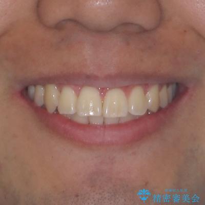 八重歯を無理なくなおしたい ワイヤー装置による非抜歯矯正治療の治療後(顔貌)