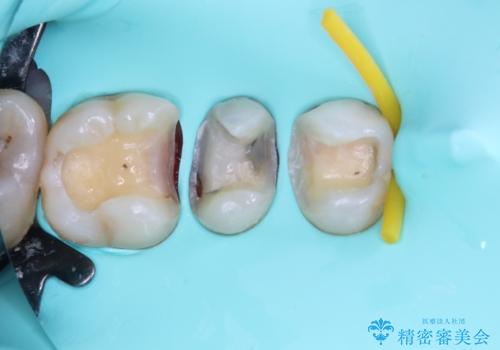 銀歯をなくしたい 全顎的なむし歯治療の治療中