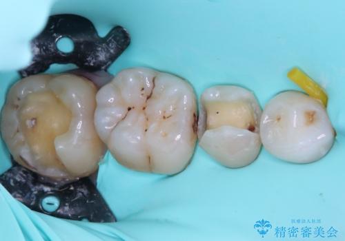 銀歯をなくしたい 全顎的なむし歯治療の治療中